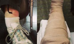 Broken Ankle (Bimalleolar Fracture) - From Break to Splint