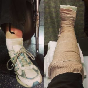 Broken Ankle (Bimalleolar Fracture) - From Break to Splint