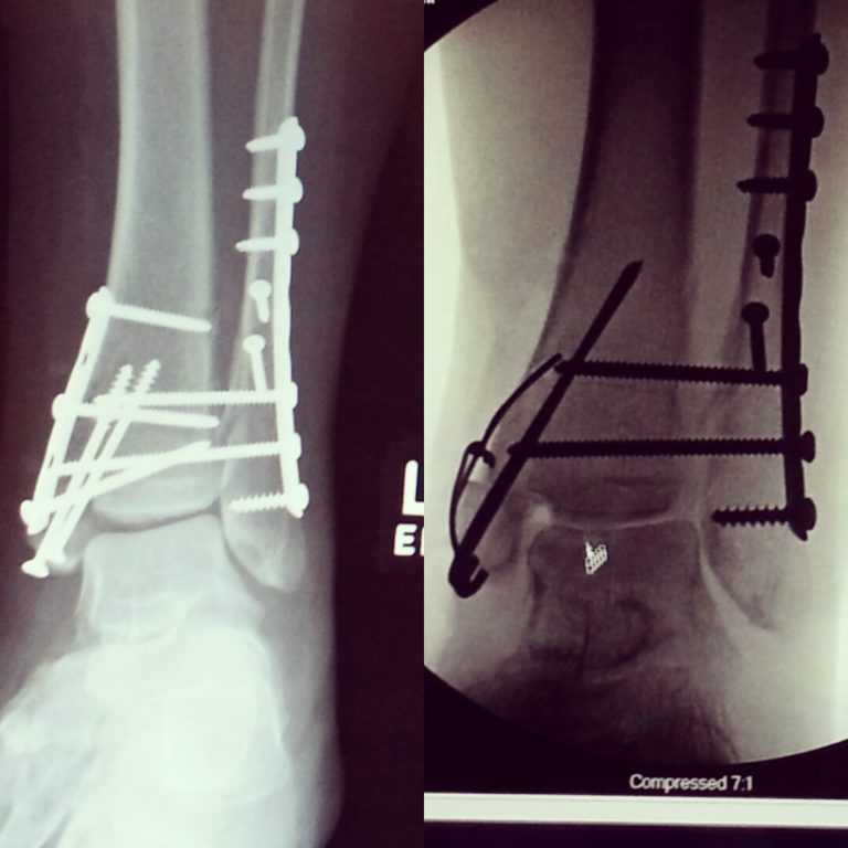 Broken ankle surgery #2 - From over-reduced to starting over.